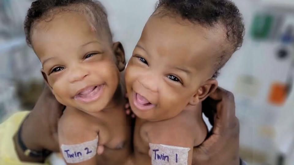 Conjoined Twins Azaria and Azora Elson Successfully Separated in Saudi Arabia Surgery